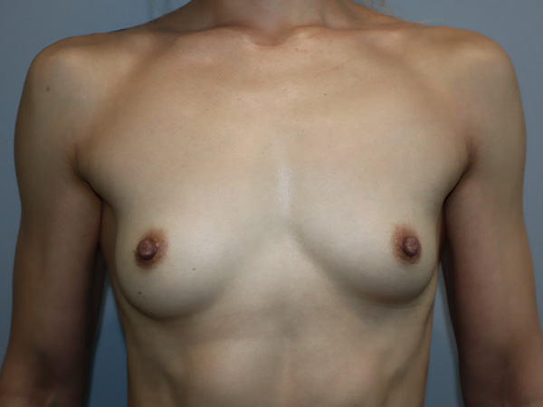 Preservé By Motiva Before and After | Grover Aesthetics