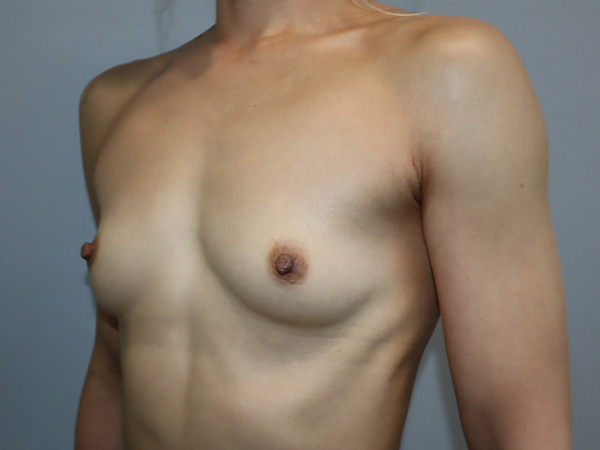 Preservé By Motiva Before and After 52 | Grover Aesthetics