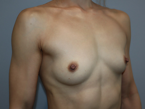 Preservé By Motiva Before and After 52 | Grover Aesthetics