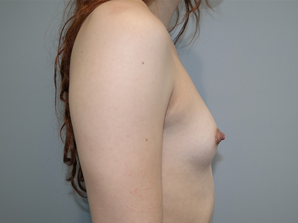 Scarless Breast Augmentation Before and After 02 | Grover Aesthetics
