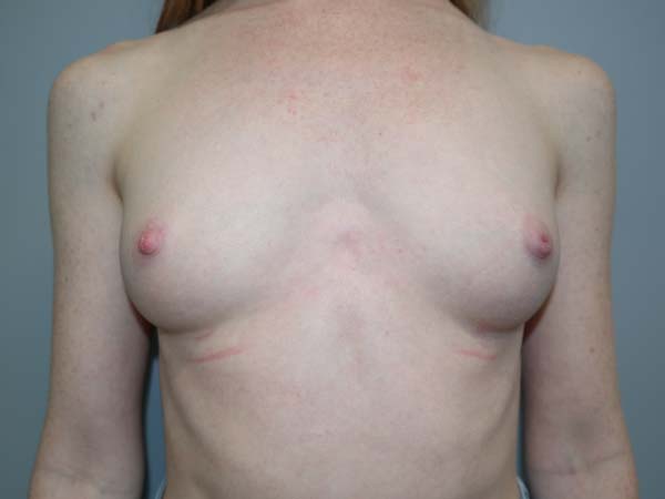 Scarless Breast Augmentation Before and After | Grover Aesthetics