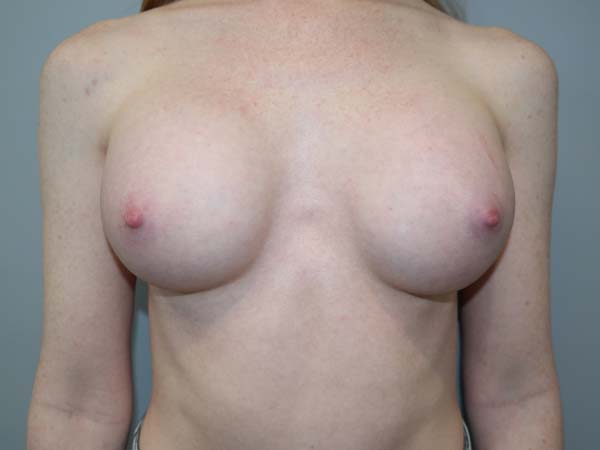 Scarless Breast Augmentation Before and After | Grover Aesthetics
