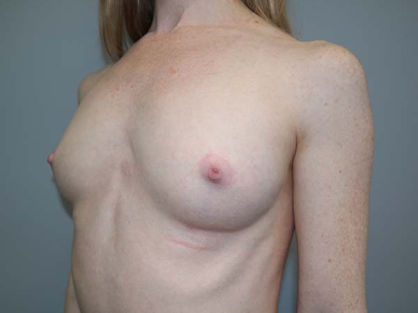 Scarless Breast Augmentation Before and After 03 | Grover Aesthetics