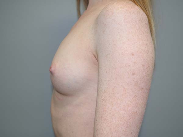 Scarless Breast Augmentation Before and After 03 | Grover Aesthetics