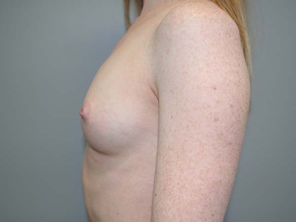 Scarless Breast Augmentation Before and After 03 | Sanjay Grover MD FACS