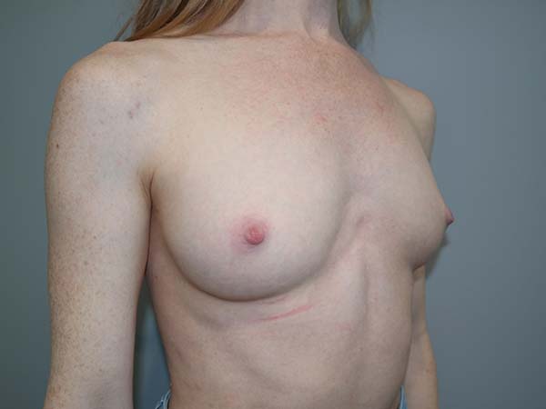 Scarless Breast Augmentation Before and After 03 | Grover Aesthetics