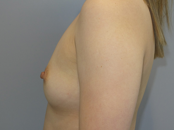 Scarless Breast Augmentation Before and After 04 | Grover Aesthetics