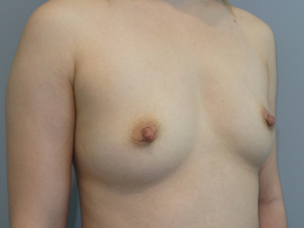 Scarless Breast Augmentation Before and After 04 | Grover Aesthetics