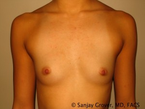 Scarless Breast Augmentation Before and After 03 | Sanjay Grover MD FACS