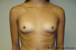 Scarless Breast Augmentation Before and After 01 | Sanjay Grover MD FACS