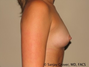 Scarless Breast Augmentation Before and After 07 | Grover Aesthetics