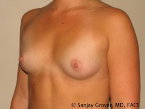 Scarless Breast Augmentation Before and After 07 | Grover Aesthetics
