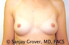 Scarless Breast Augmentation Before and After 02 | Sanjay Grover MD FACS