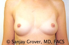 Scarless Breast Augmentation Before and After | Grover Aesthetics