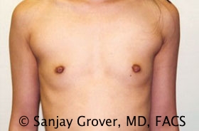 Scarless Breast Augmentation Before and After 06 | Sanjay Grover MD FACS