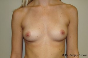 Scarless Breast Augmentation Before and After 05 | Sanjay Grover MD FACS