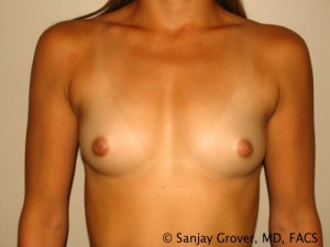 Scarless Breast Augmentation Before and After | Grover Aesthetics