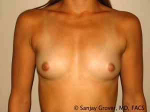 Scarless Breast Augmentation Before and After 10 | Sanjay Grover MD FACS