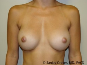 Scarless Breast Augmentation Before and After | Grover Aesthetics