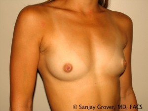 Scarless Breast Augmentation Before and After 11 | Grover Aesthetics