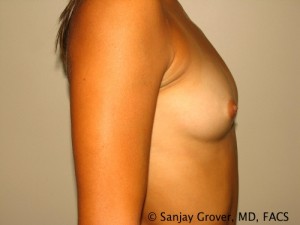 Scarless Breast Augmentation Before and After 11 | Grover Aesthetics