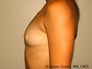 Scarless Breast Augmentation Before and After 11 | Grover Aesthetics