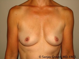 Breast Augmentation Before and After 159 | Sanjay Grover MD FACS