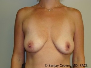 Breast Augmentation Before and After 309 | Sanjay Grover MD FACS