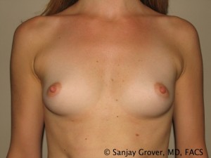 Breast Augmentation Before and After 257 | Sanjay Grover MD FACS