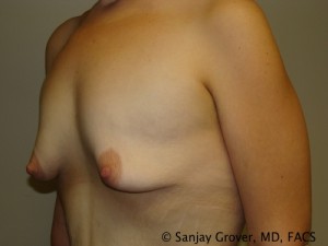 Breast Augmentation Before and After 124 | Sanjay Grover MD FACS