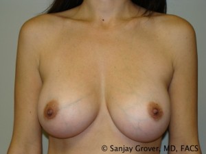 Breast Augmentation Before and After 127 | Sanjay Grover MD FACS