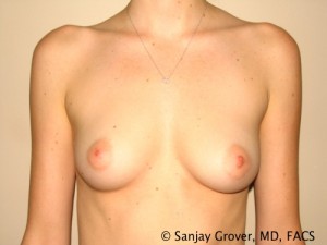 Breast Augmentation Before and After 07 | Sanjay Grover MD FACS