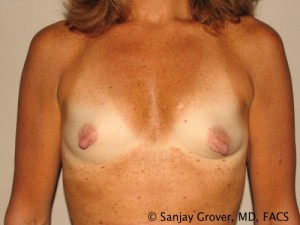 Breast Augmentation Before and After 280 | Sanjay Grover MD FACS