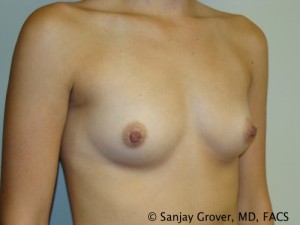 Breast Augmentation Before and After 159 | Sanjay Grover MD FACS