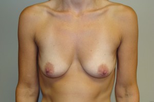 Breast Augmentation Before and After 18 | Sanjay Grover MD FACS