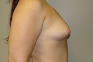 Breast Augmentation Before and After 199 | Sanjay Grover MD FACS