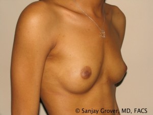 Breast Augmentation Before and After 20 | Sanjay Grover MD FACS
