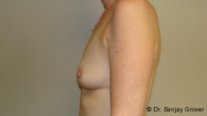 Breast Augmentation Before and After 202 | Sanjay Grover MD FACS