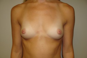 Breast Augmentation Before and After 130 | Sanjay Grover MD FACS