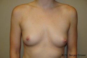 Breast Augmentation Before and After 04 | Sanjay Grover MD FACS