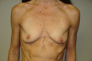 Breast Augmentation Before and After 143 | Sanjay Grover MD FACS