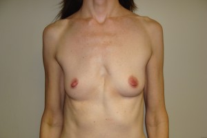 Breast Augmentation Before and After 306 | Sanjay Grover MD FACS