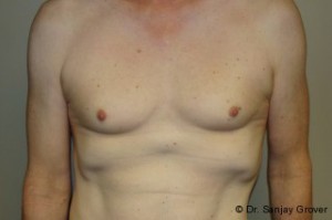Breast Augmentation Before and After 199 | Sanjay Grover MD FACS