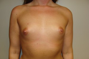 Breast Augmentation Before and After 134 | Sanjay Grover MD FACS