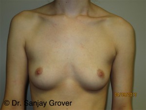 Breast Augmentation Before and After 149 | Sanjay Grover MD FACS
