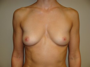 Breast Augmentation Before and After 127 | Sanjay Grover MD FACS