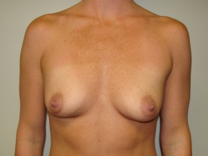 Breast Augmentation Before and After 16 | Sanjay Grover MD FACS