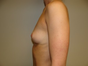 Breast Augmentation Before and After 303 | Sanjay Grover MD FACS