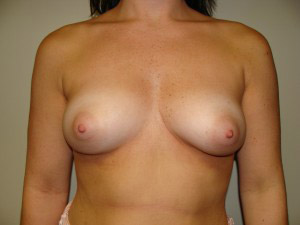 Breast Augmentation Before and After 73 | Sanjay Grover MD FACS