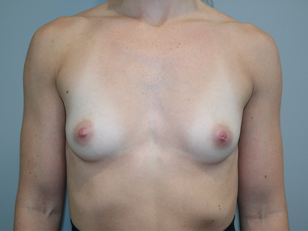 Breast Augmentation Before and After 210 | Sanjay Grover MD FACS